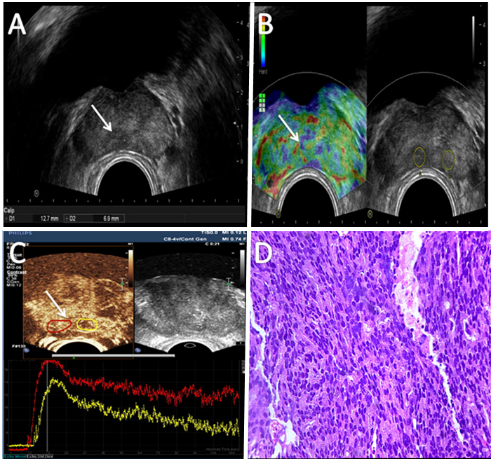 The Value Of Contrast Enhanced Ultrasonography Combined With Real Time Strain Elastography In