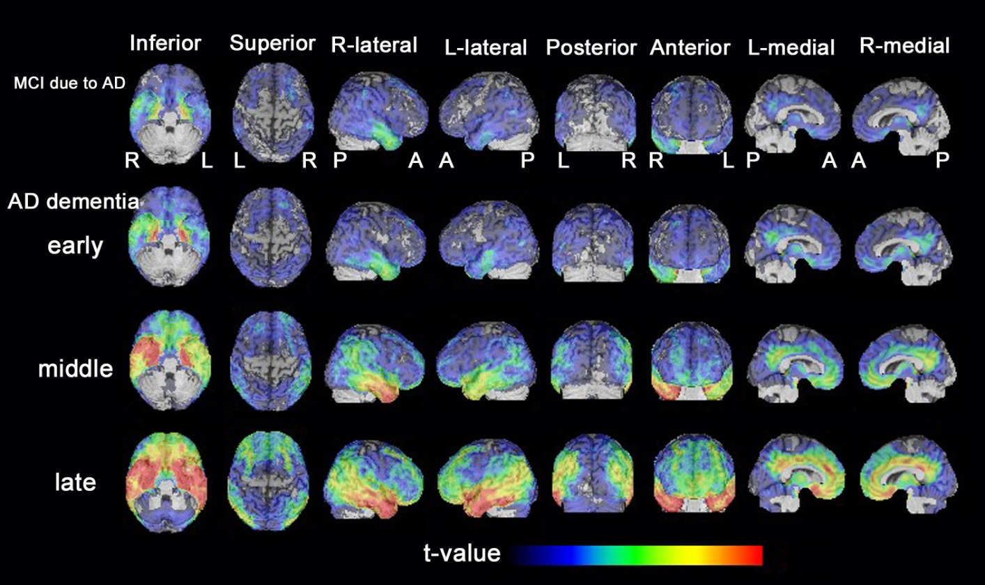 voxel-based-morphometry-of-brain-mri-in-normal-aging-and-alzheimer-s