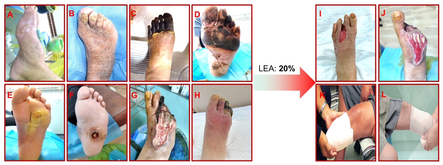 Revolutionizing Diabetic Foot Ulcer Care: The Senotherapeutic Approach