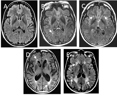 Neuroimaging of Cerebrovascular Disease in the Aging Brain