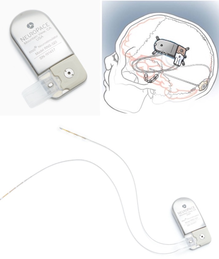 Neuromodulation in Drug Resistant Epilepsy